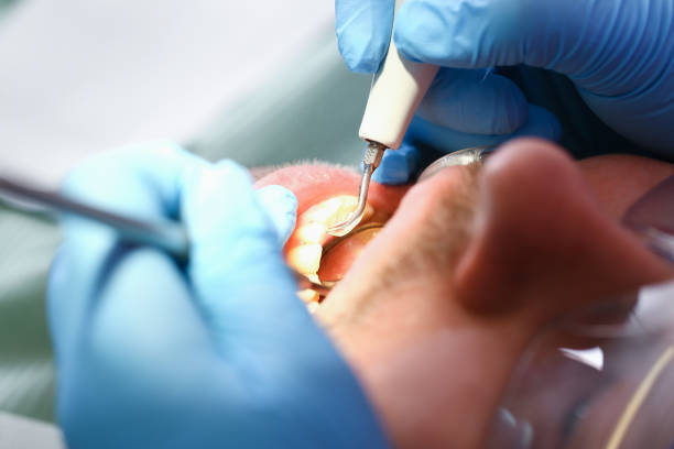 Best Emergency Gum Treatment in Bremen, IN